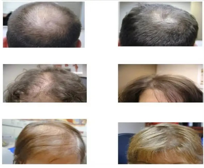 Six Needles Scalp Applicator（11）